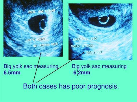 can an enlarged yolk sac correct itself|EP04.23: Pregnancy outcome in patients with large .